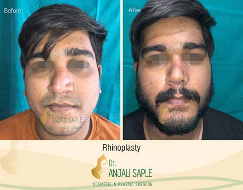 Rhinoplasty front view by Dr. Anjali Saple 4