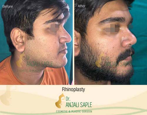 Rhinoplasty side view by Dr. Anjali Saple 1