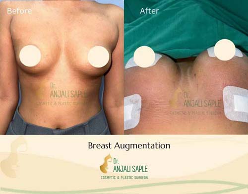 Breast Augmentation case by Sonia