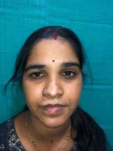 1 month post-op case by Sunandini Padhy