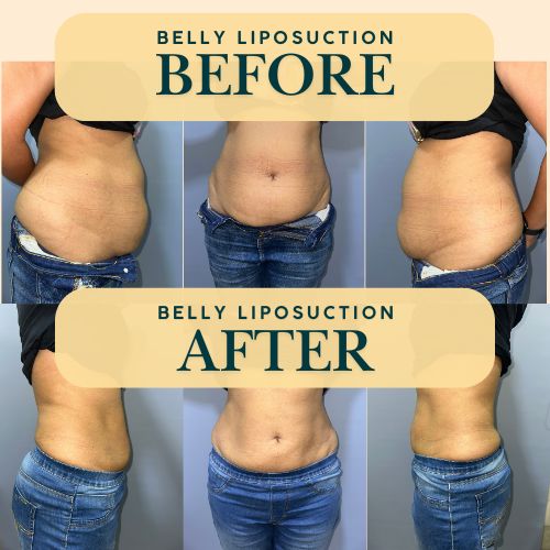 Belly Liposuction