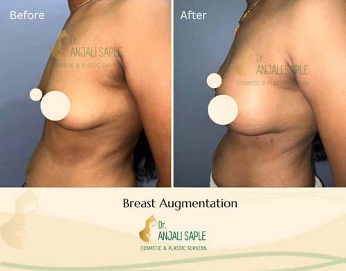 Breast augmentation left view by Swapna