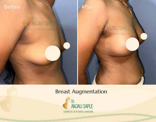 Breast augmentation right view by Swapna