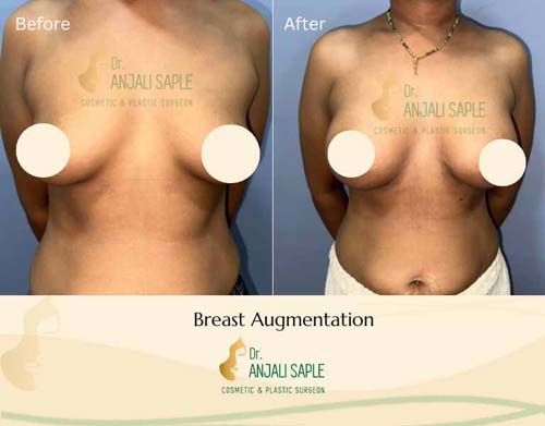 Breast augmentation case by Swapna