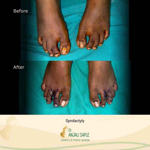 Syndactyly case