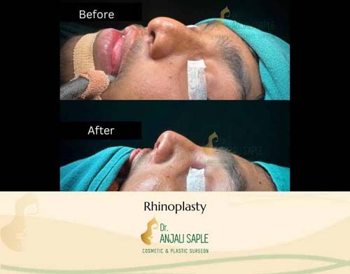 Rhinoplasty left view by Venkat