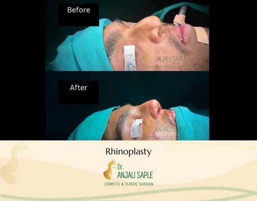 Rhinoplasty right view by Venkat