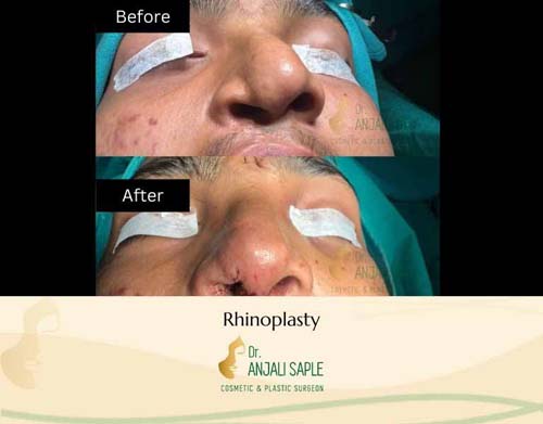 Rhinoplasty case by Venkat