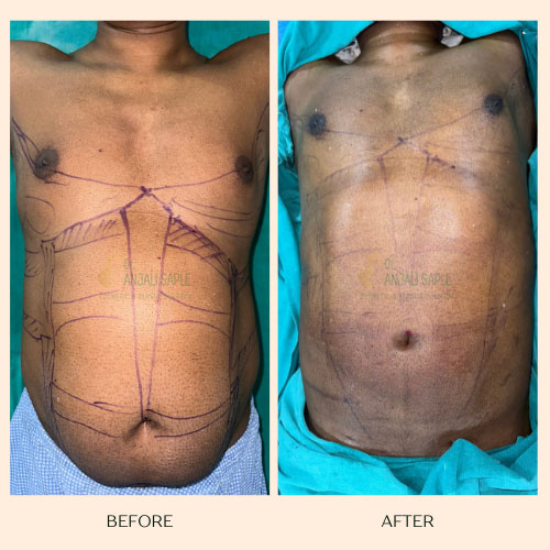 Abdomen liposuction