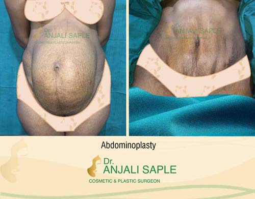 Before-After: Tummy Tuck
