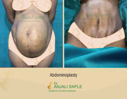 Abdominoplasty before and after case by Dr. Anjali Saple 3