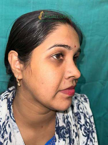 After 8 months post treatment facial reconstruction by Dr. Anjali Saple side-view-2