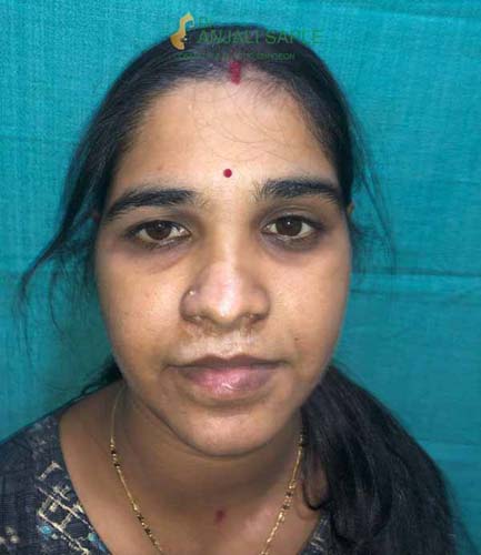 Sunandini Padhy 1 Month Post-Op