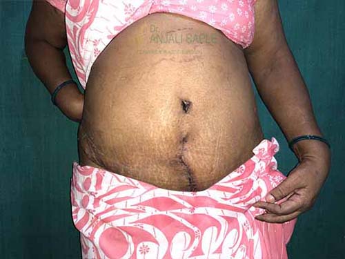 Post-operation hernia case by Dr. Anjali Saple