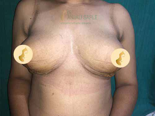 Post-operation mastopexy case by Dr. Anjali Saple
