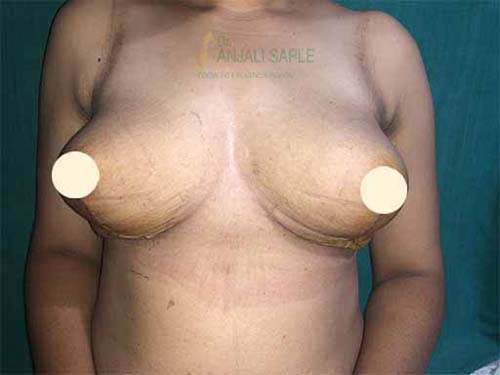 Post-operation mastopexy case by Dr. Anjali Saple 3