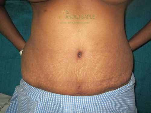 Post-operation tummy tuck case by Dr. Anjali Saple 1