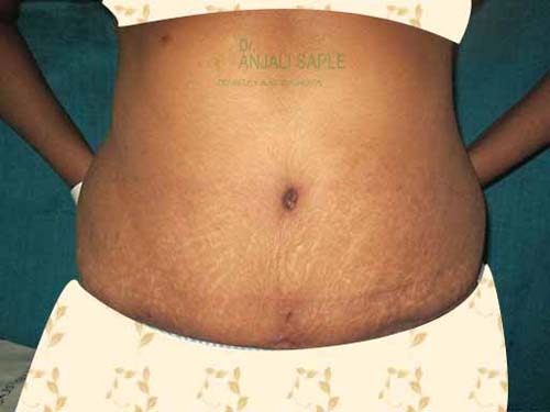 Post-operation tummy tuck case by Dr. Anjali Saple 3