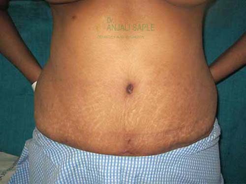 Post-operation tummy tuck case by Dr. Anjali Saple