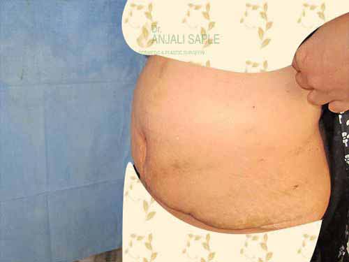 Post-operation left side view tummy tuck by Dr. Anjali Saple