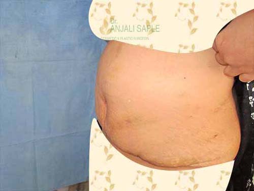 Post-operation left side view tummy tuck by Dr. Anjali Saple 2