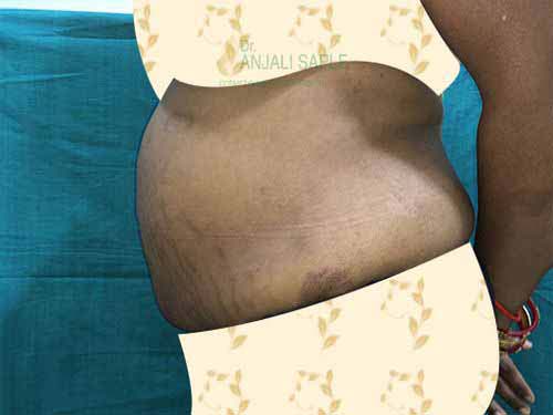 Post-operation left side view tummy tuck by Dr. Anjali Saple 3