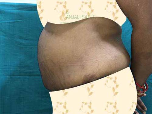 Post-operation left side view tummy tuck by Dr. Anjali Saple 3
