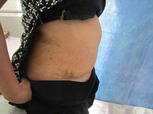 Post-operation right side view tummy tuck by Dr. Anjali Saple 1