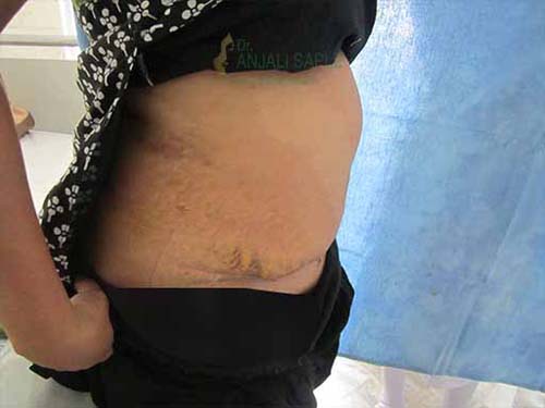 Post-operation right side view tummy tuck by Dr. Anjali Saple 2
