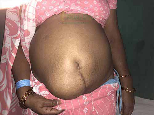 Before hernia surgery by Dr. Anjali Saple