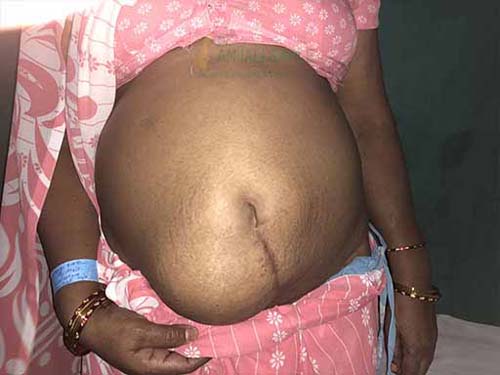 Before hernia operation case by Dr. Anjali Saple