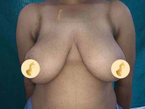 Before mastopexy surgery by Dr. Anjali Saple