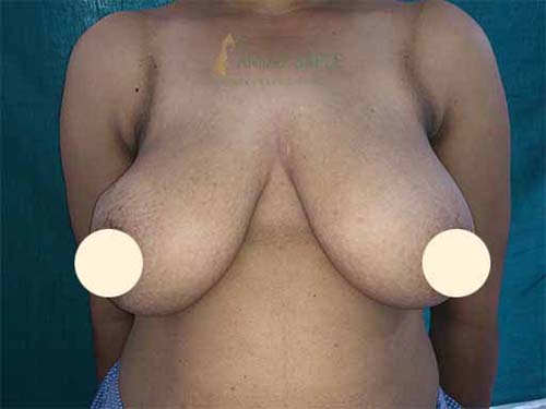 Before mastopexy surgery case by Dr. Anjali Saple 3