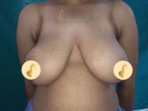 Before mastopexy surgery case by Dr. Anjali Saple 4
