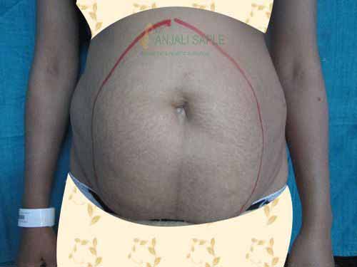 Before tummy tuck surgery case by Dr. Anjali Saple 2