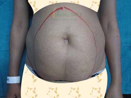 Before tummy tuck surgery case by Dr. Anjali Saple 3