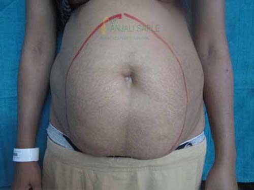 Before tummy tuck case by Dr. Anjali Saple