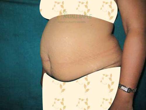 Before tummy tuck left side view case by Dr. Anjali Saple 2