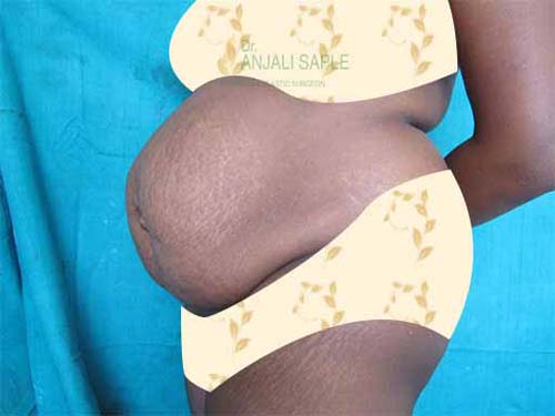 Before tummy tuck left side view by Dr. Anjali Saple