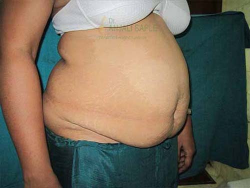Before tummy tuck right side view case by Dr. Anjali Saple