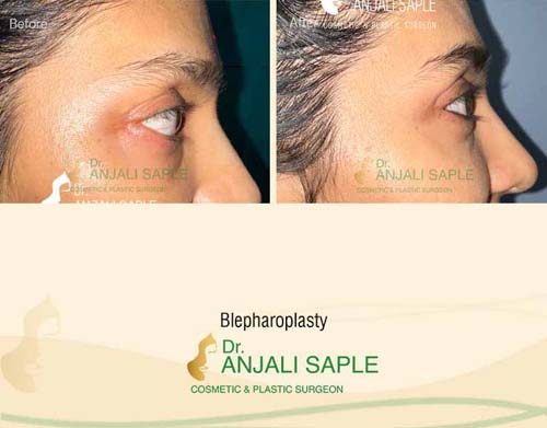 Eyelid surgery side view by Dr. Anjali Saple 1