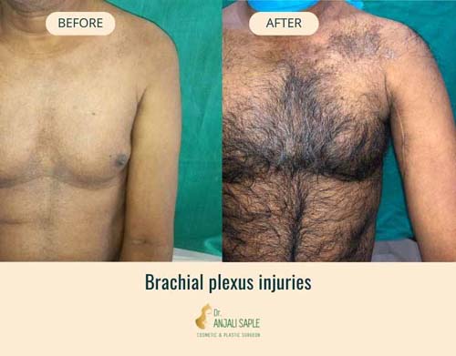 Brachial plexus injuries before and after case