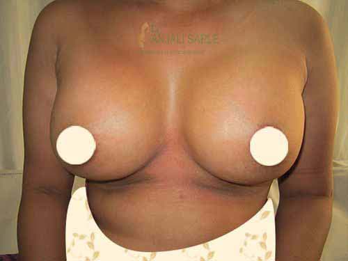 Post-operation breast augmentation 2 by Dr. Anjali Saple