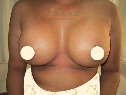 Post-operation breast augmentation 3 by Dr. Anjali Saple