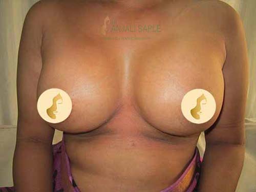 Post-operation breast augmentation by Dr. Anjali Saple