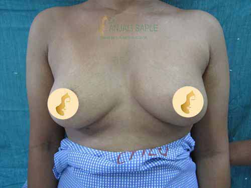 Before breast augmentation case by Dr. Anjali Saple 1