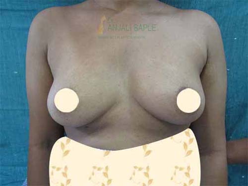 Before breast augmentation 2 by Dr. Anjali Saple