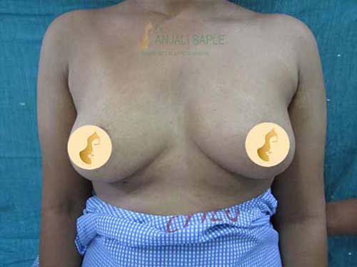 Before breast augmentation by Dr. Anjali Saple