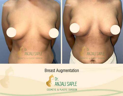 Breast augmentation before and after front view by Dr. Anjali Saple 8