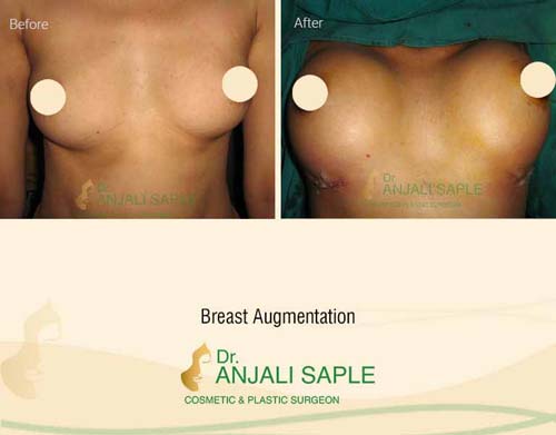Breast augmentation before and after front view by Dr. Anjali Saple 1
